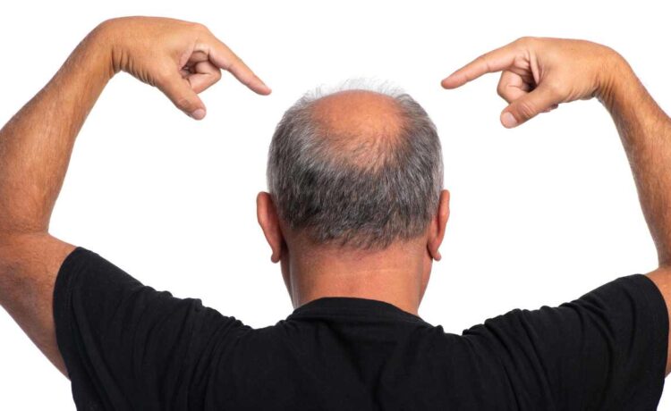 Influência hereditária na queda de cabelo: Entenda o impacto dos genes na sua saúde capilar 1 Design sem nome 37