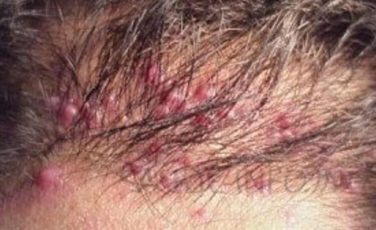Conheça as causas, sintomas e tratamentos disponíveis para foliculite no couro cabeludo 1 abelo frizz 7